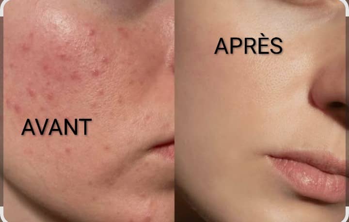 Masque visage traite (rides + taches noire + acné)